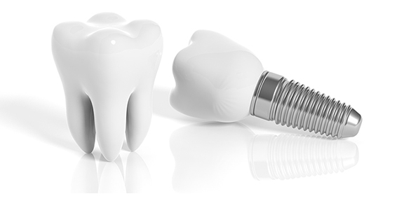 321 Implantes dentales