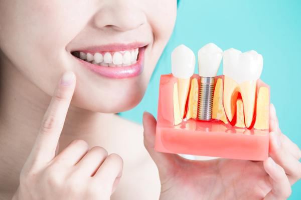 4432 Implantes dentales