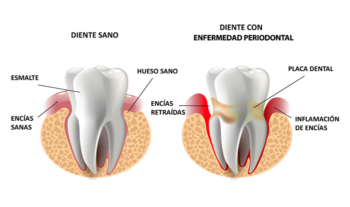 PERIODONTAL PERIODONTAL