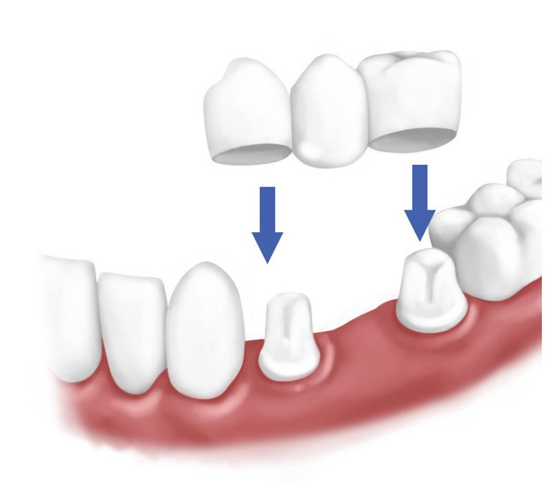 puente-dental Prótesis dental